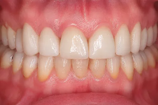 veneer and crown smile makeover | Dentist in Stoke on Trent
