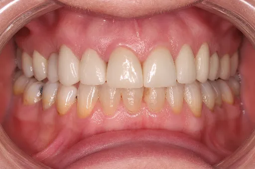 veneer and crown smile makeover | Dentist in Stoke on Trent