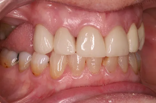 veneer and crown smile makeover | Dentist in Stoke on Trent