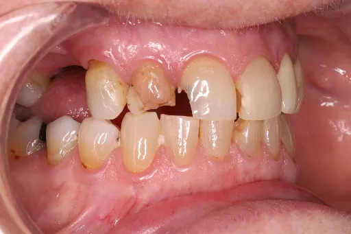 veneer and crown smile makeover | Dentist in Stoke on Trent