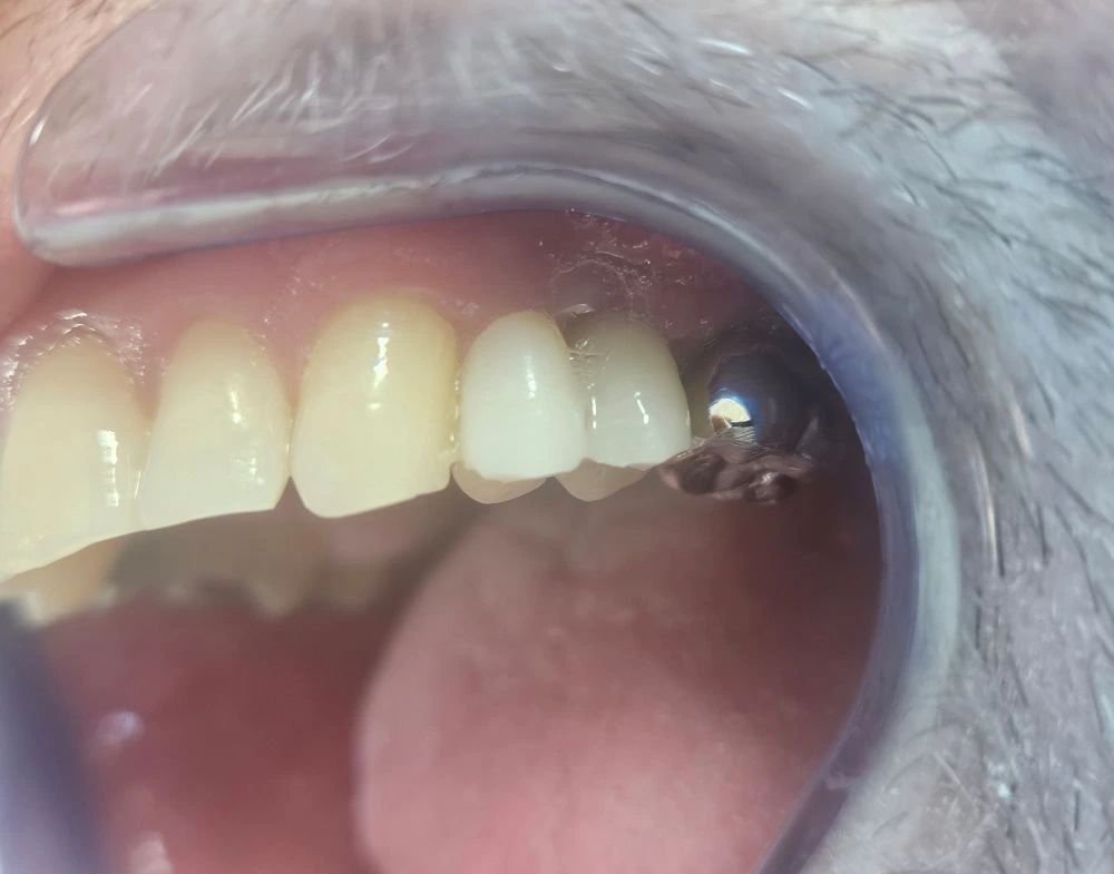 Dental Implant & Fixed Bridge | Dentist in Stoke on Trent