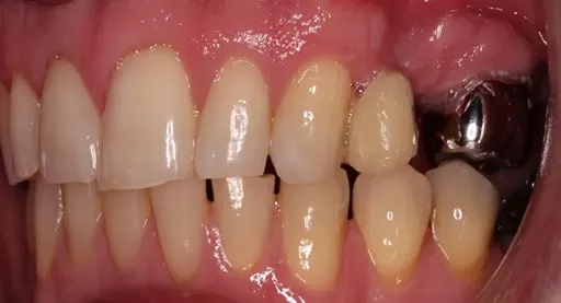 Dental Implant & Fixed Bridge | Dentist in Stoke on Trent