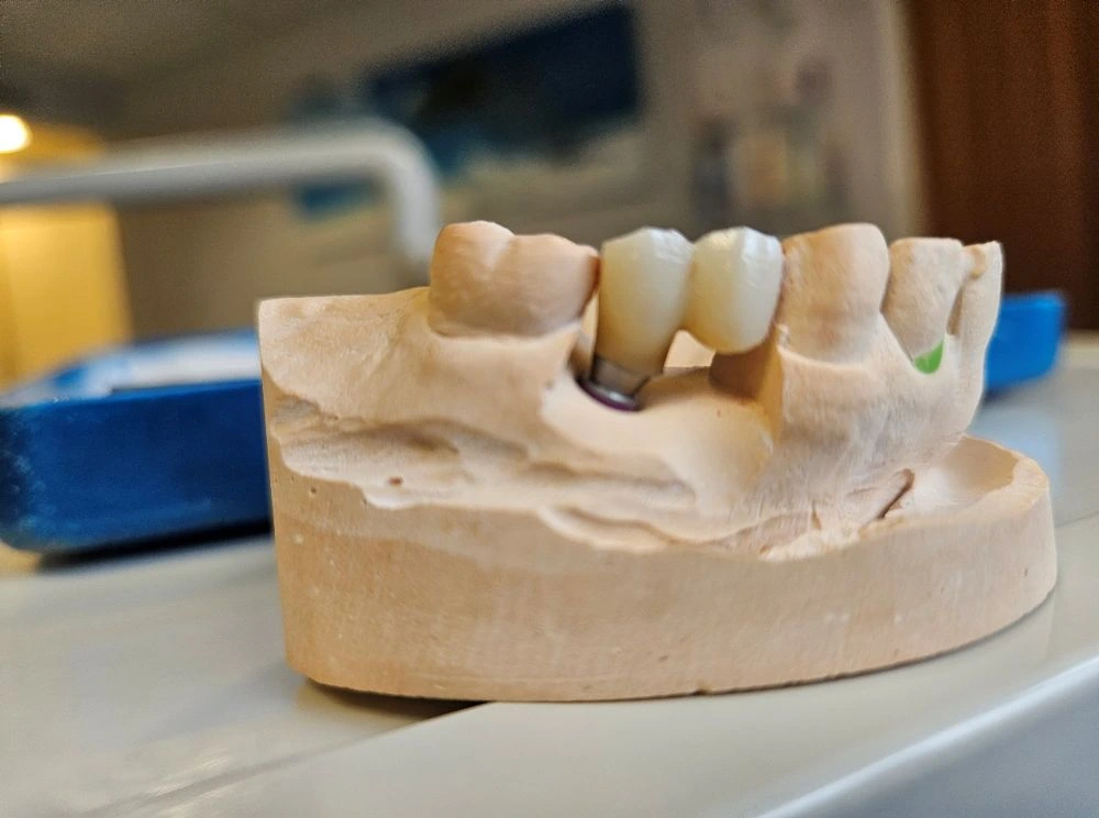 Dental Implant & Fixed Bridge | Dentist in Stoke on Trent
