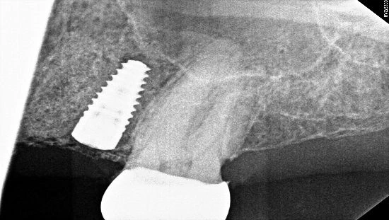 Dental Implant & Fixed Bridge | Dentist in Stoke on Trent