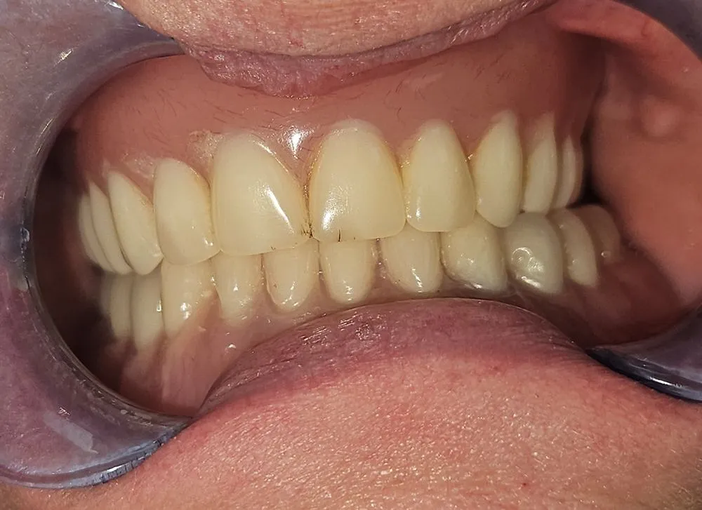 implant secured denture case study | Dentist in Stoke on Trent