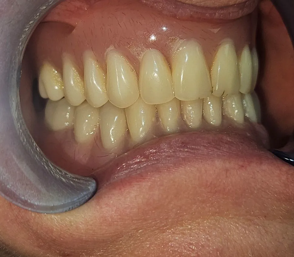 implant secured denture case study | Dentist in Stoke on Trent