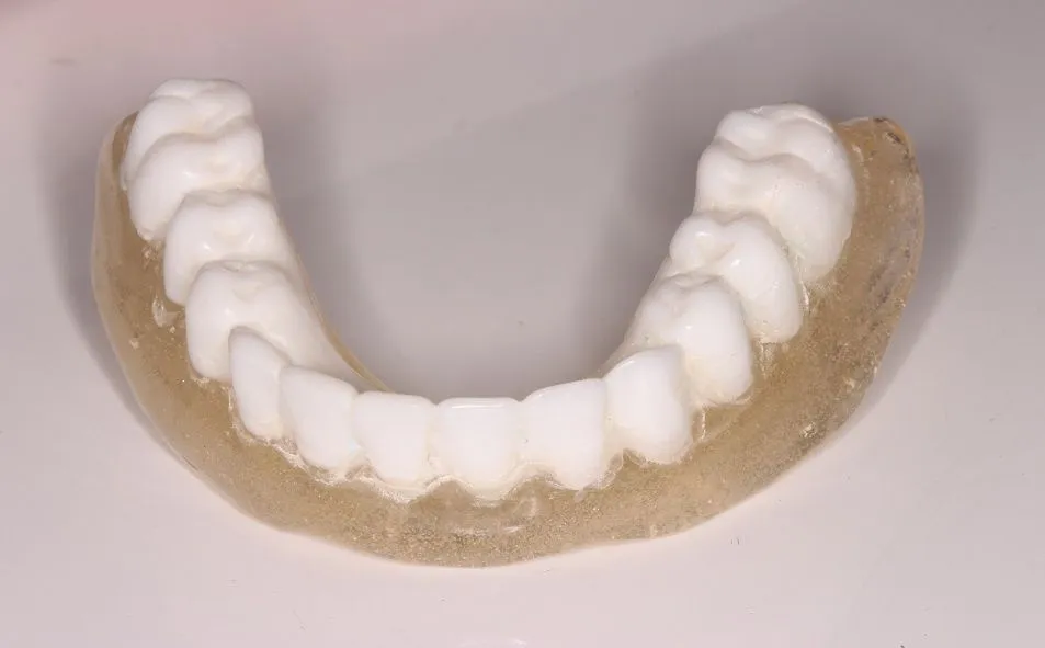 implant secured denture case study | Dentist in Stoke on Trent