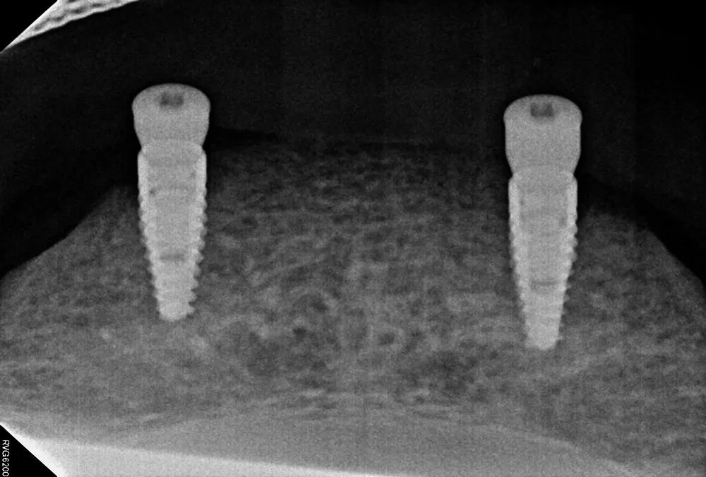 implant secured denture case study | Dentist in Stoke on Trent