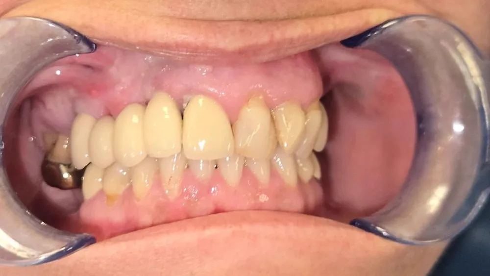 full mouth rebuild case study | Dentist in Stoke on Trent