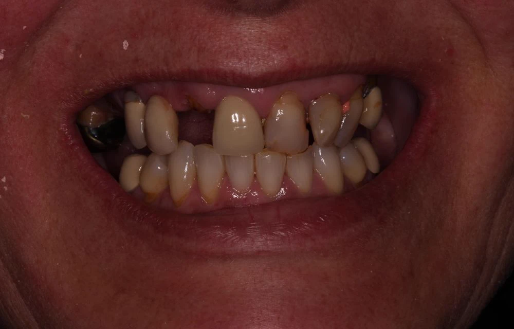 full mouth rebuild case study | Dentist in Stoke on Trent