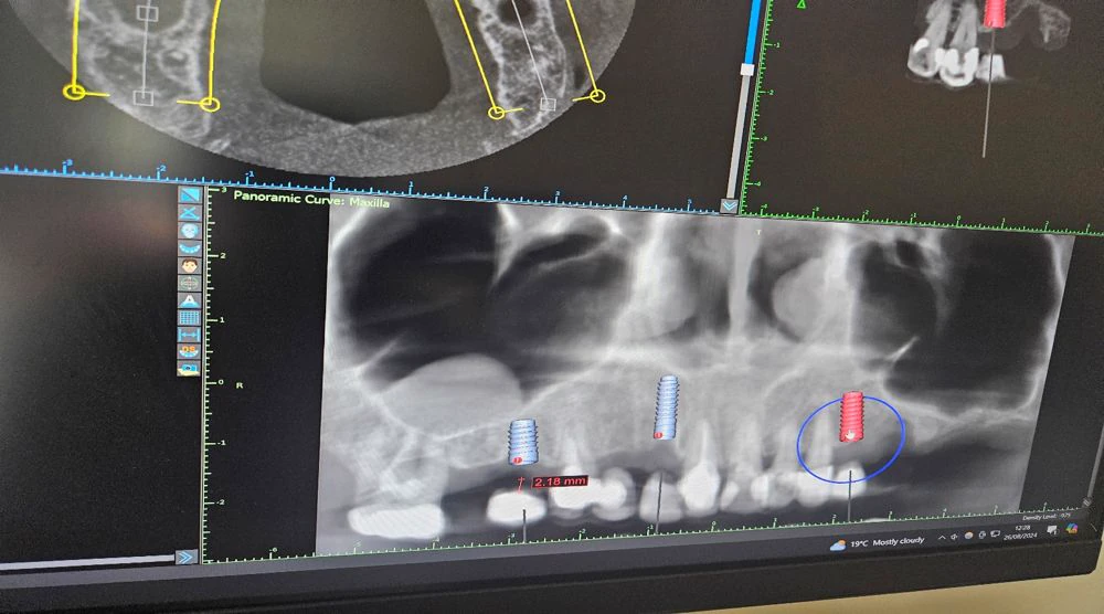 full mouth rebuild case study | Dentist in Stoke on Trent
