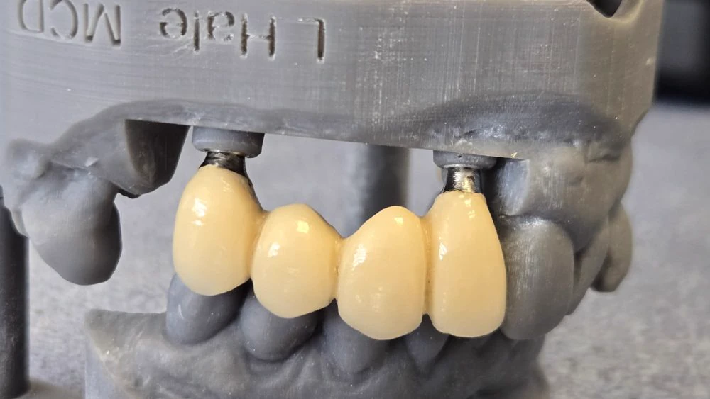full mouth rebuild case study | Dentist in Stoke on Trent