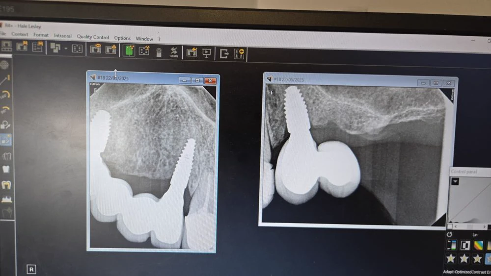full mouth rebuild case study | Dentist in Stoke on Trent