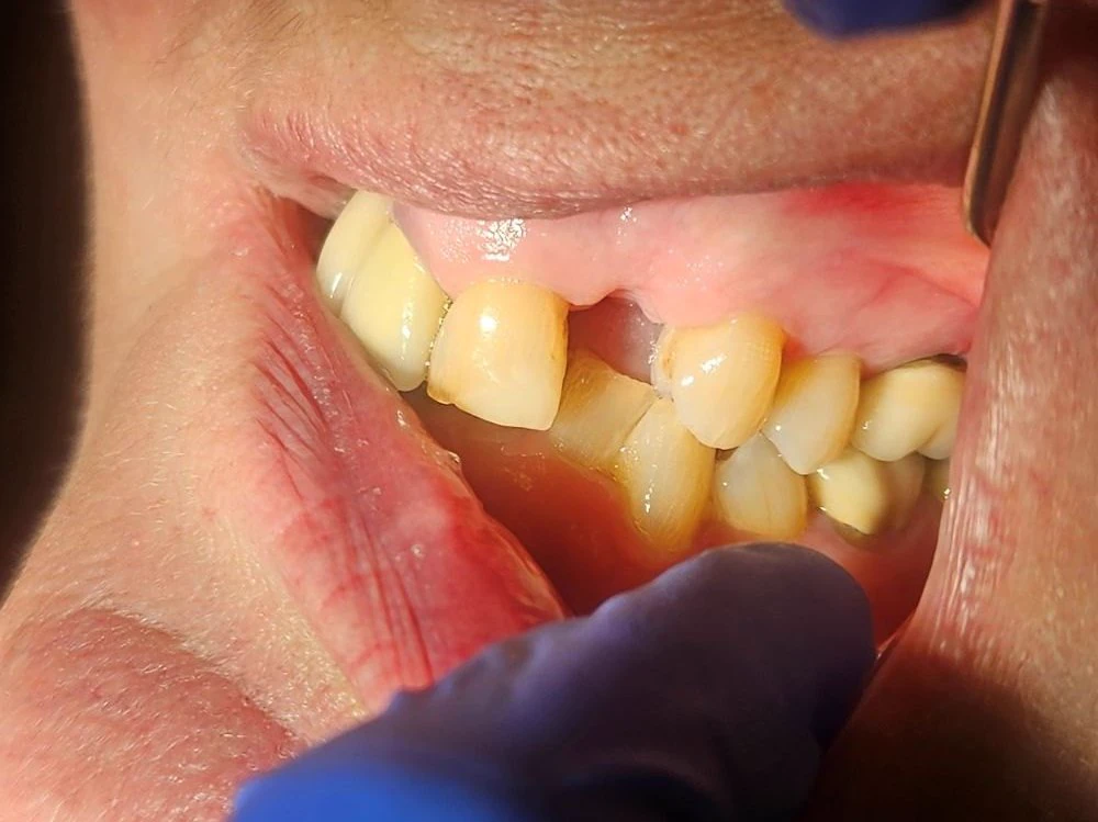 front tooth implant case study | Dentist in Stoke on Trent