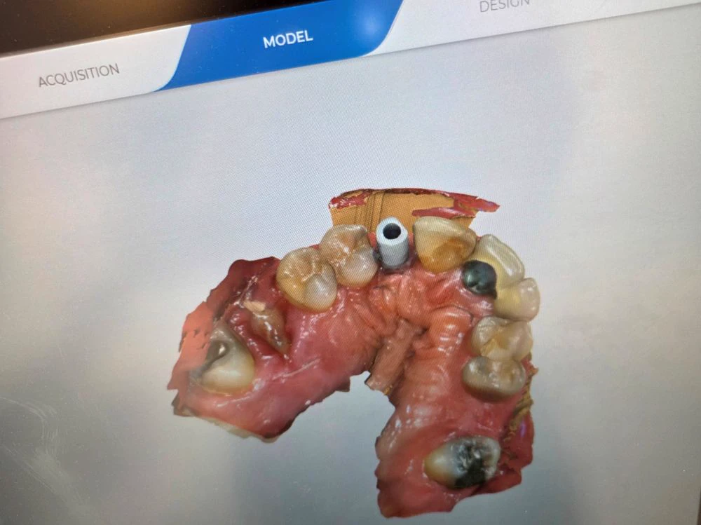 front tooth implant case study | Dentist in Stoke on Trent