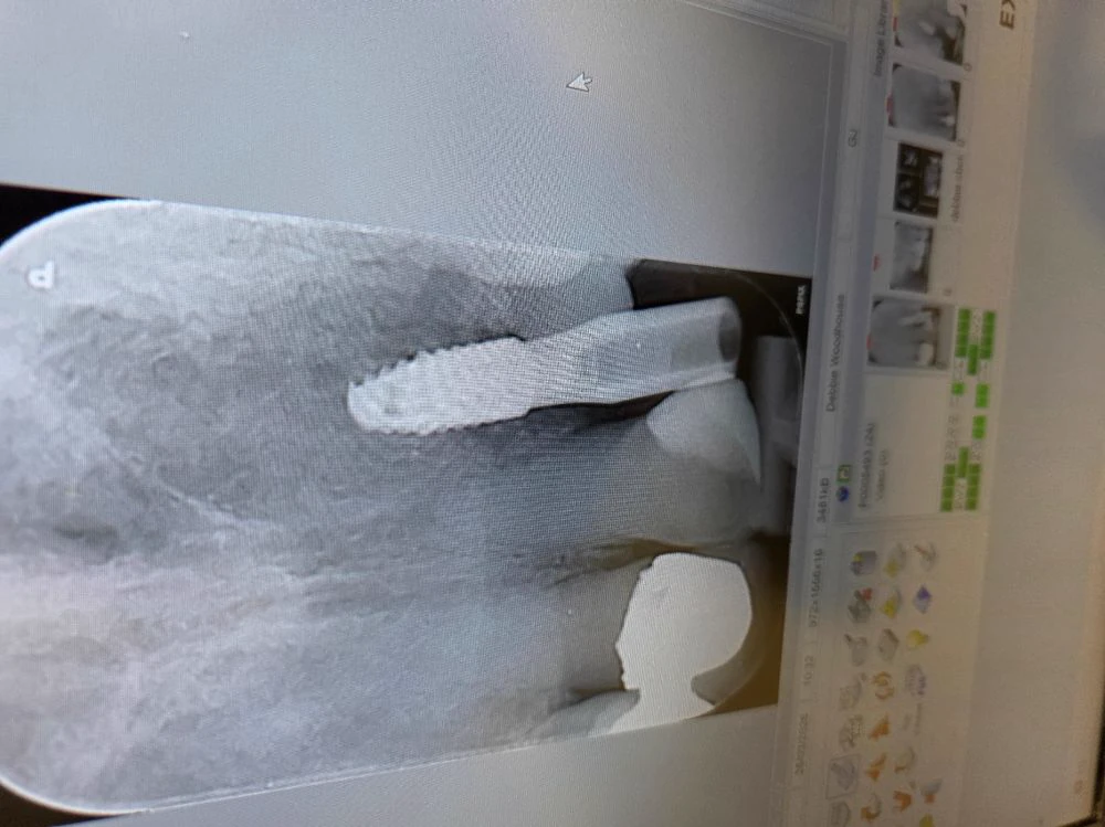 front tooth implant case study | Dentist in Stoke on Trent