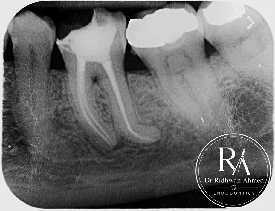 root canal treatment before and after | Dentist in Stoke on Trent