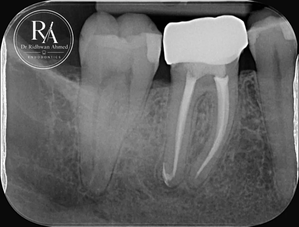 Six month review X-ray showing complete healing around the root ends after root canal re-treatment