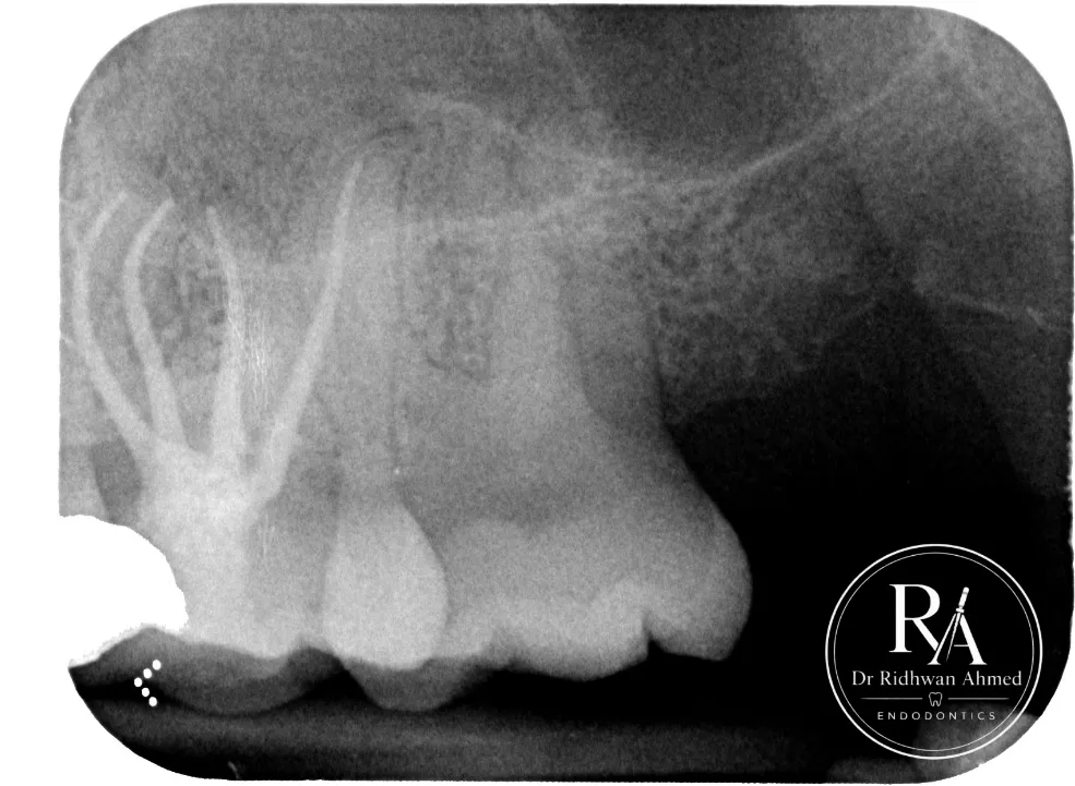 Upper left first molar after minimal access root canal treatment, view 1