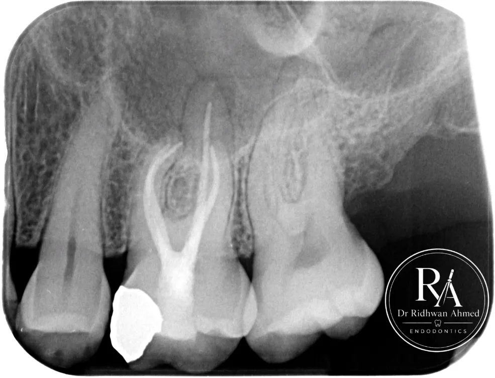 Upper left first molar after minimal access root canal treatment, view 2