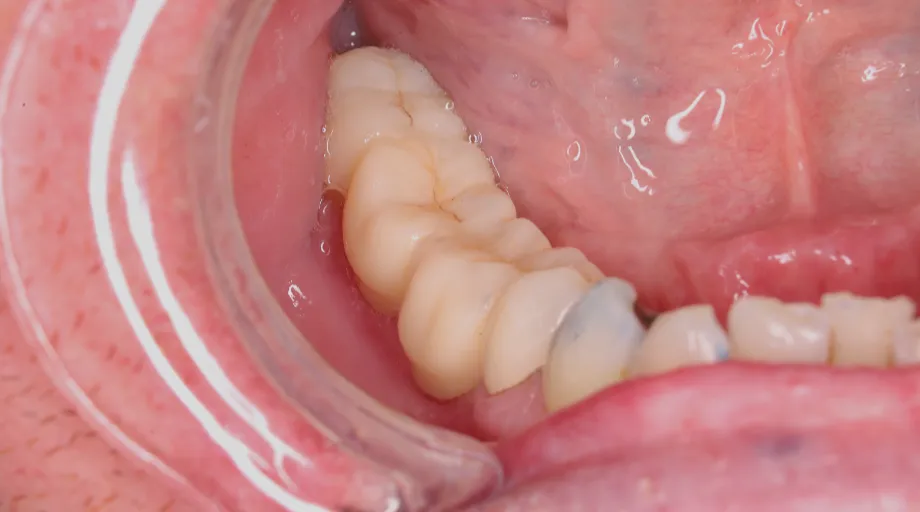 Four-unit zirconia bridge replacing missing molars, view 1