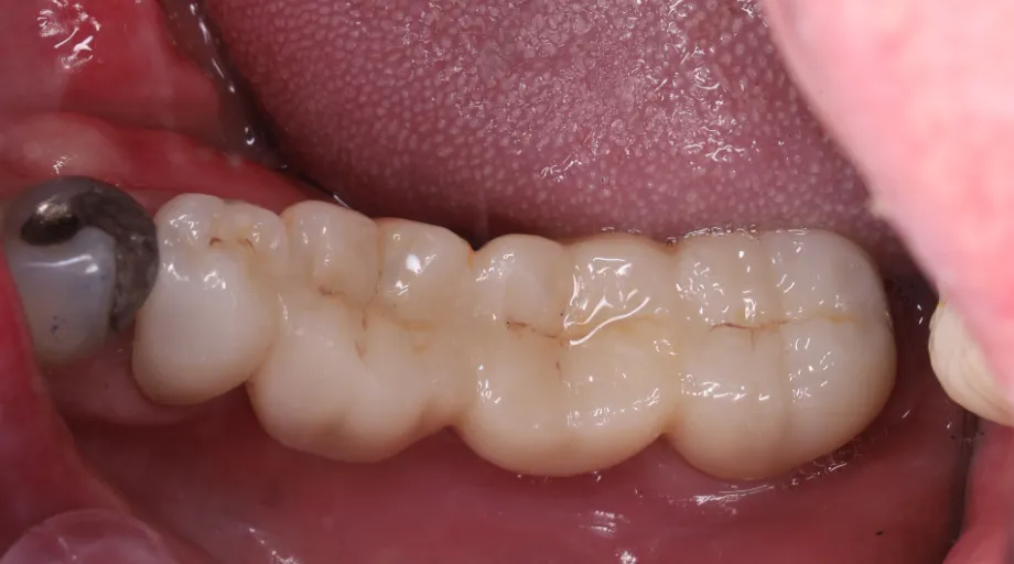 Four-unit zirconia bridge replacing missing molars, view 2