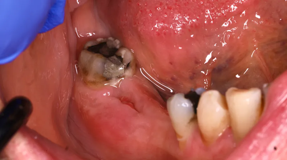 Missing back teeth before zirconia bridge treatment
