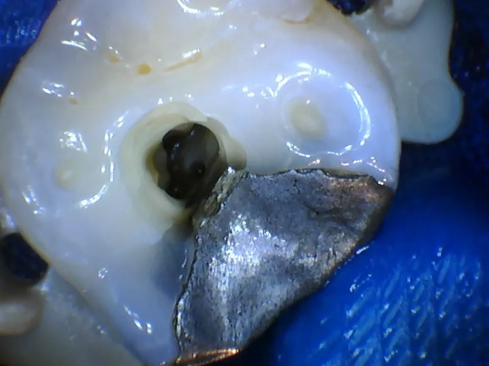 Upper left first molar before advanced root canal treatment, view 2