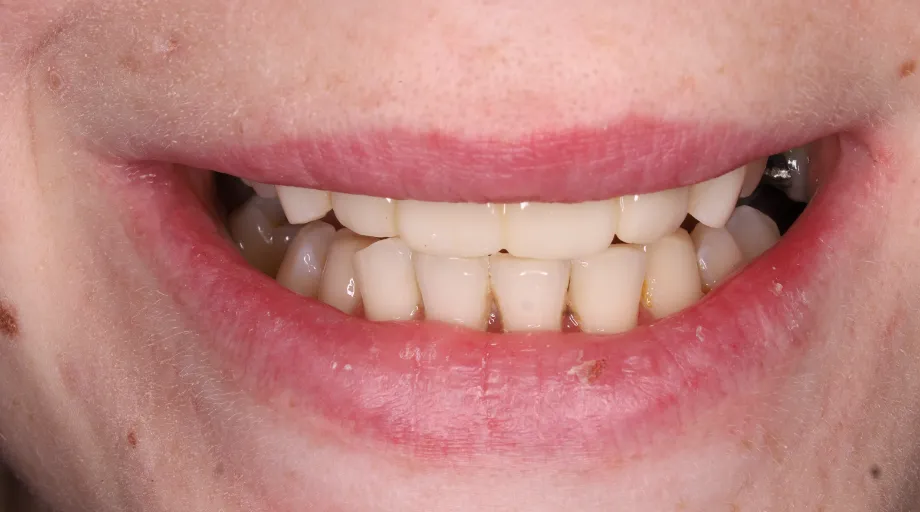 Aesthetic zirconia front teeth bridge after treatment, view 1