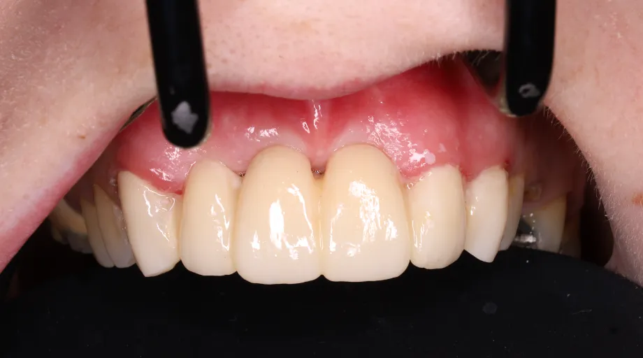 Aesthetic zirconia front teeth bridge after treatment, view 2