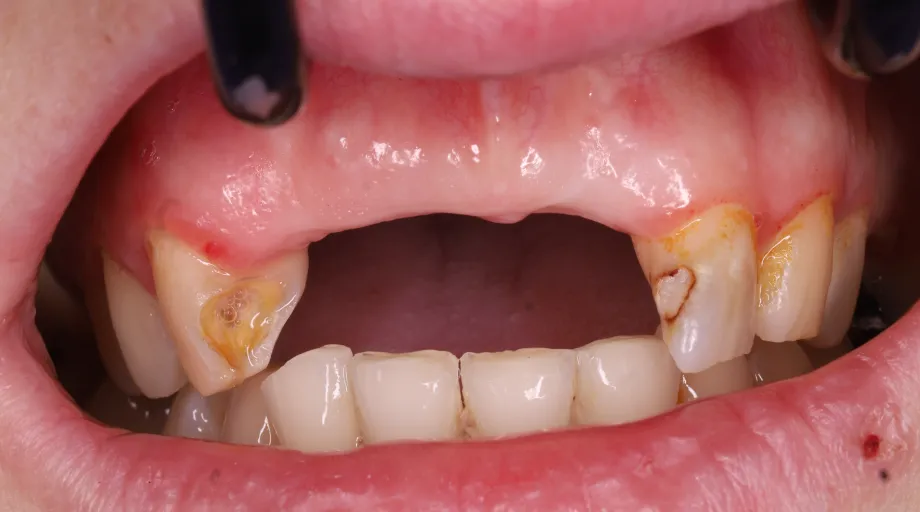 Missing upper front teeth before front teeth bridge treatment, view 1