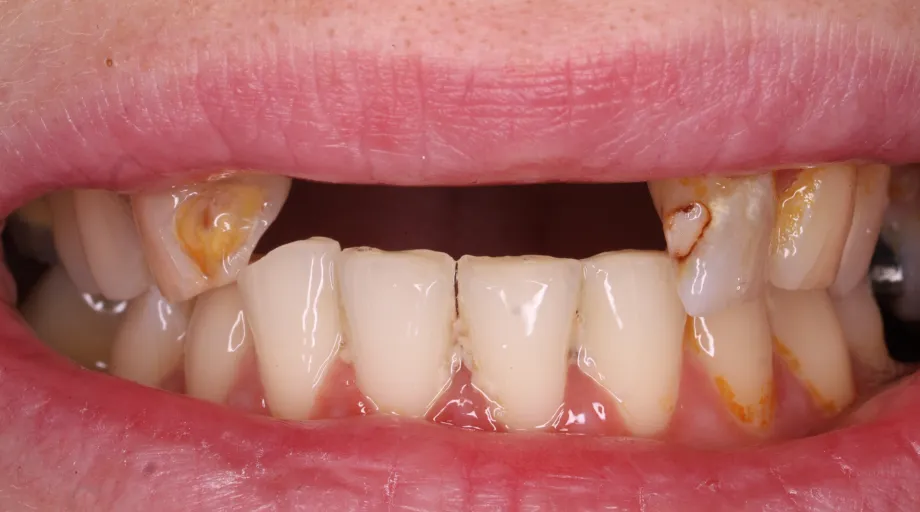 Missing upper front teeth before front teeth bridge treatment, view 2