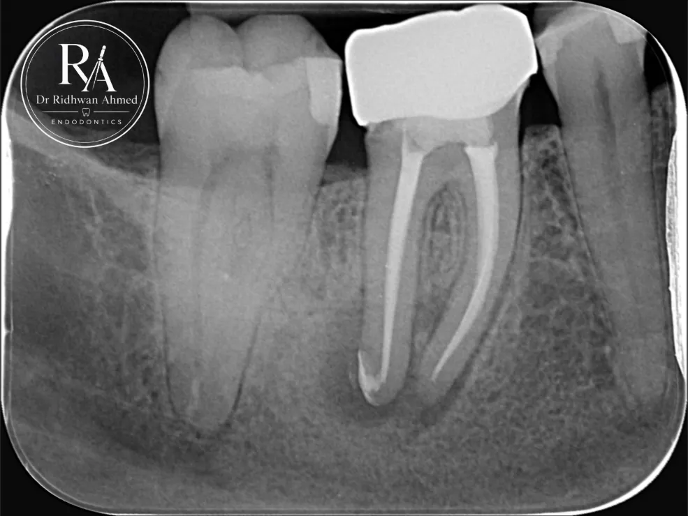 Immediate post-operative X-ray after root canal re-treatment of a severely curved root