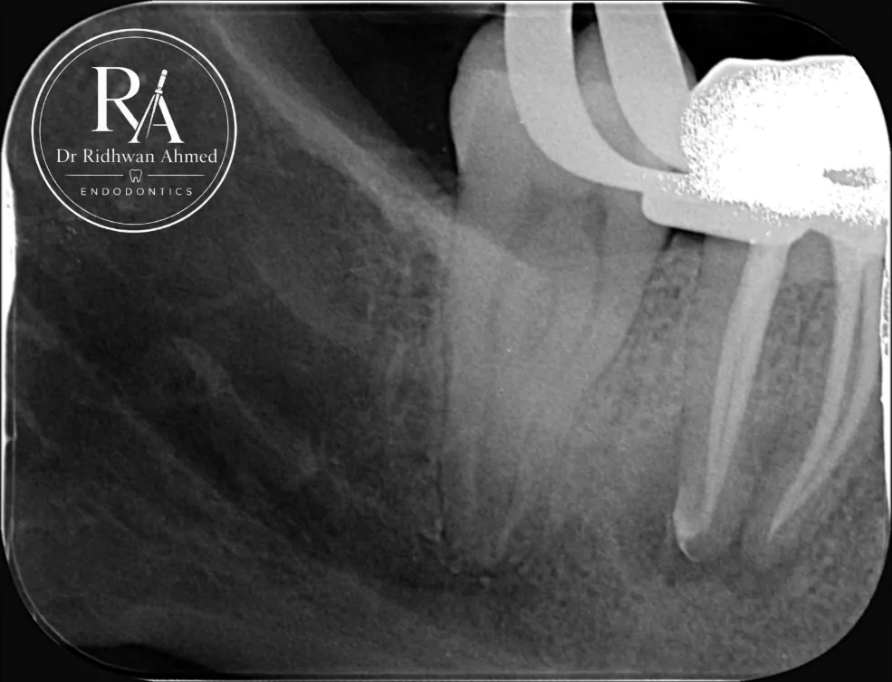 Mid-operative X-ray during root canal re-treatment showing four canals