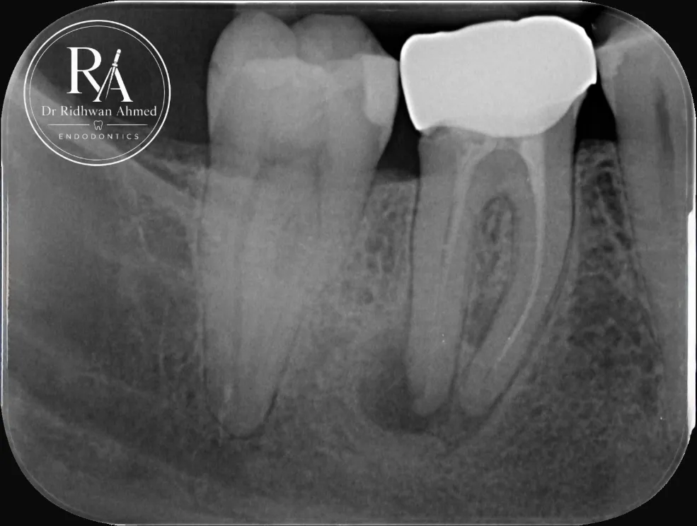 Pre-operative X-ray of a previously root-treated tooth with a large area of infection at the root ends and a severely curved root