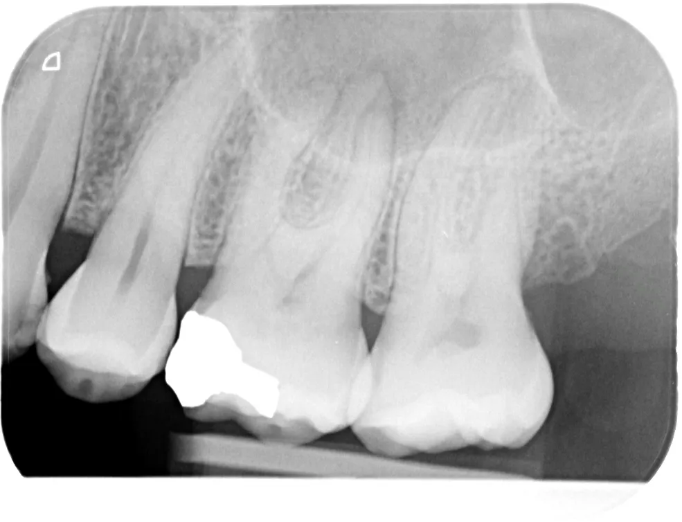 Upper left first molar before advanced root canal treatment, view 1