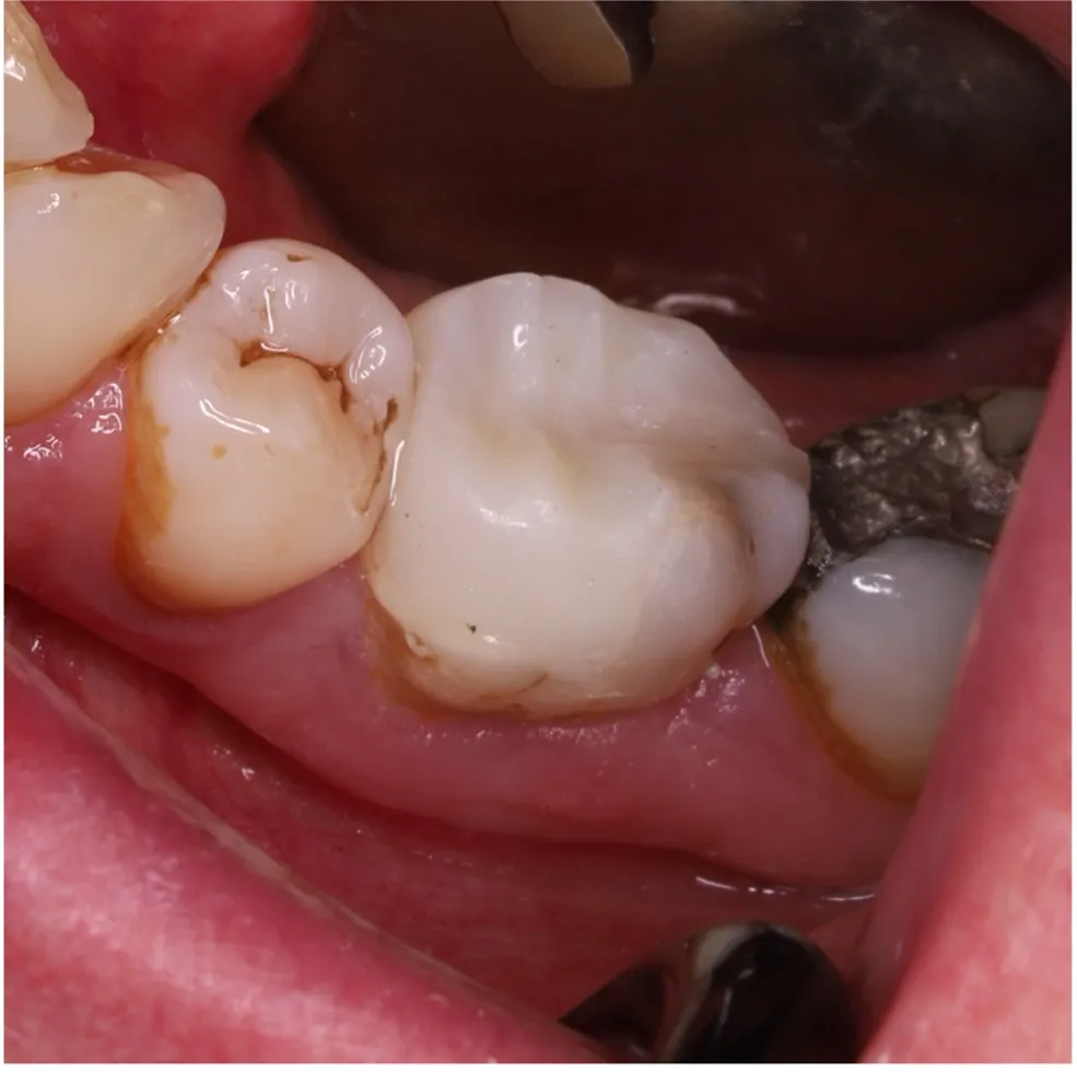 root canal treatment before and after | Dentist in Stoke on Trent