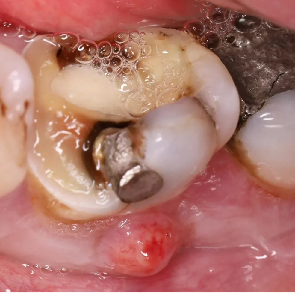 root canal treatment before and after | Dentist in Stoke on Trent