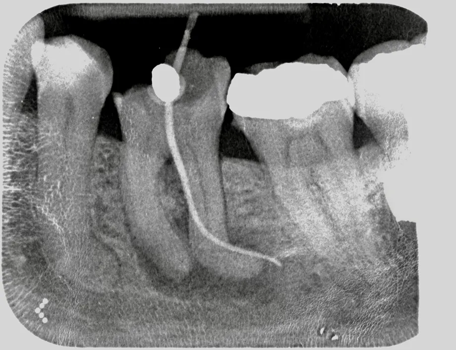 root canal treatment before and after | Dentist in Stoke on Trent